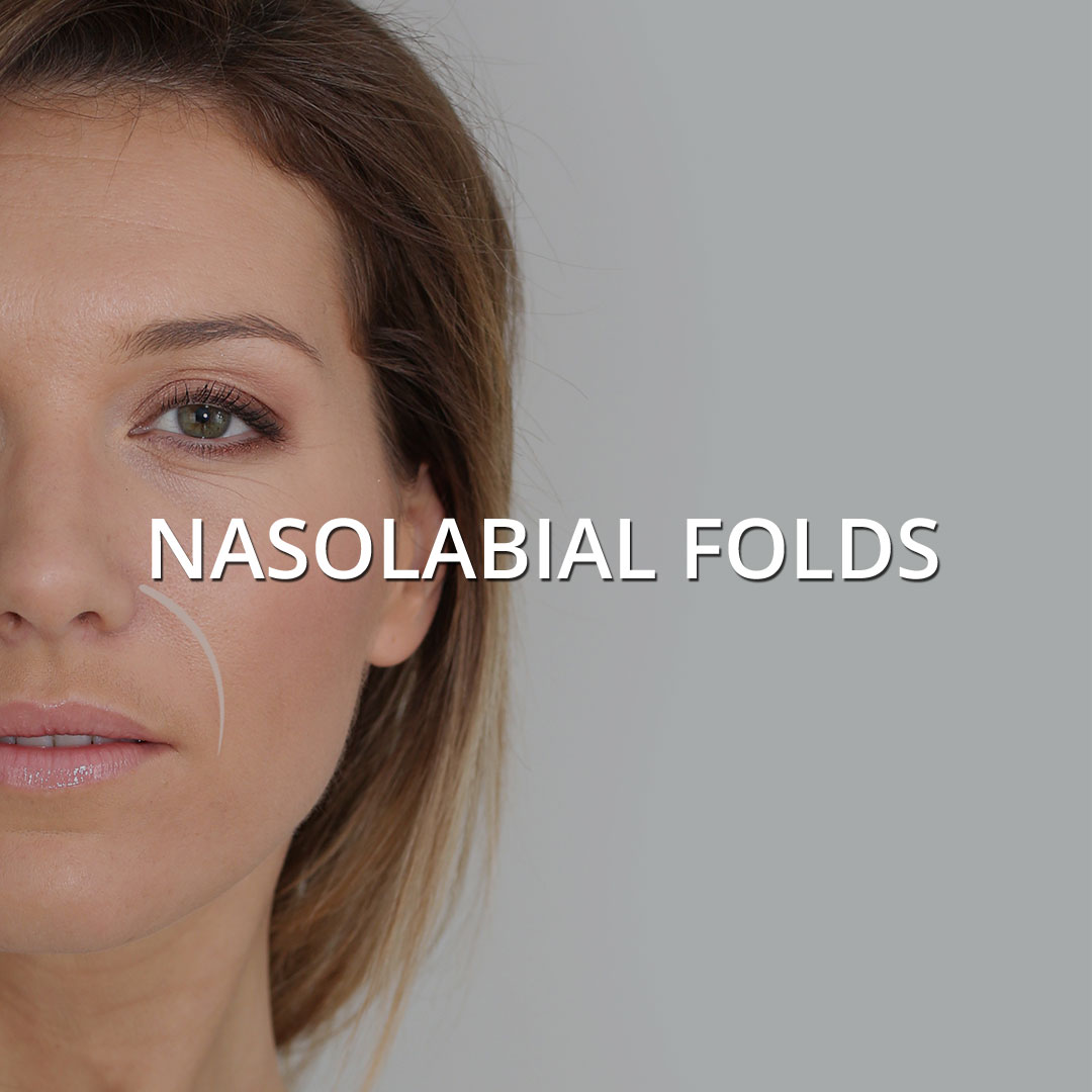 Nasolabial Folds
