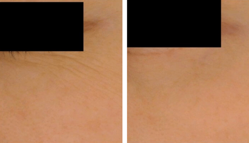 Forlle'd Hyalogy facial before and after 2