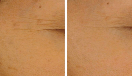 Forlle'd Hyalogy facial before and after 1