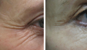 Laser Skin Resurfacing