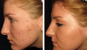 Laser Skin Resurfacing