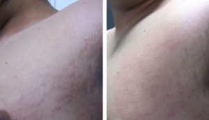 Stretch Marks