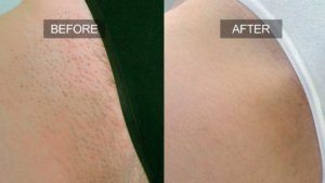 beforeafterbikini