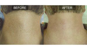 beforeafterneck