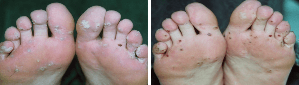 Laser plantar wart removal before and after
