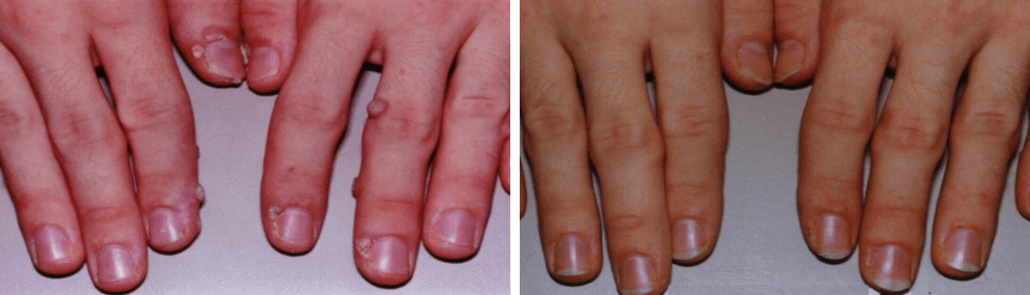 Laser removal of common warts on fingers before and after