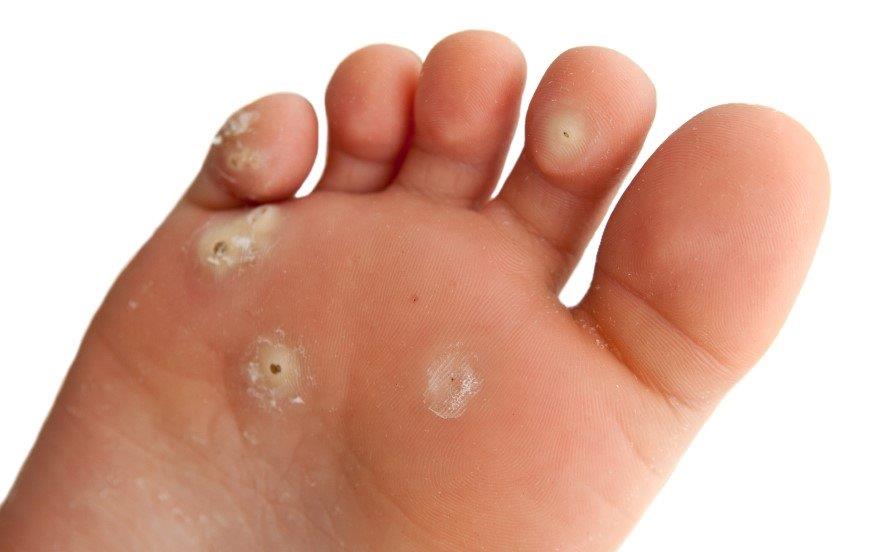 Plantar warts on the sole of the foot before laser wart removal in Vancouver