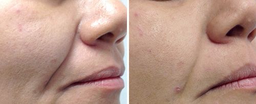 Nasolabial fold before and after Fotona 4D