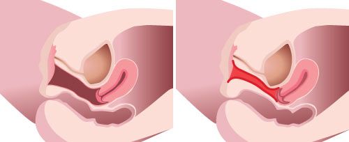 IntimaLase laser vaginal tightening diagram, vaginal canal before and after treatment