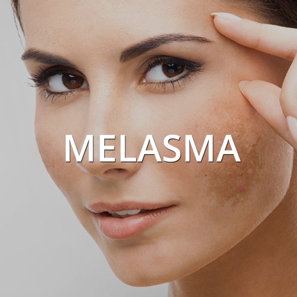 Melasma
