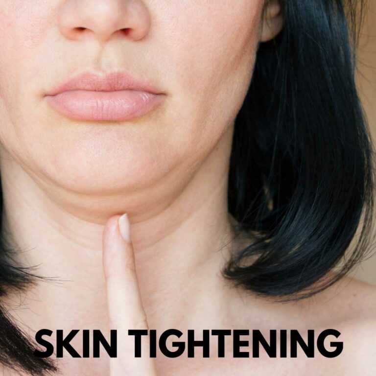 Loose Skin