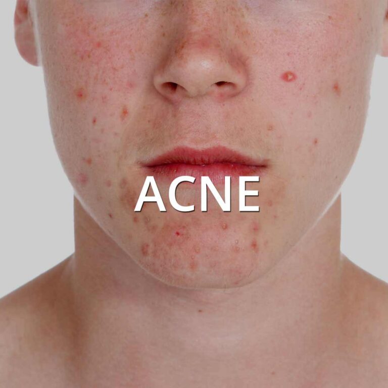 Acne & Acne Scars