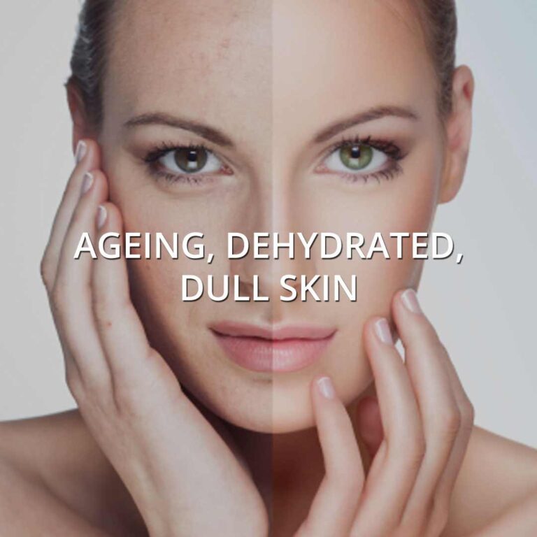 Dehydrated Skin