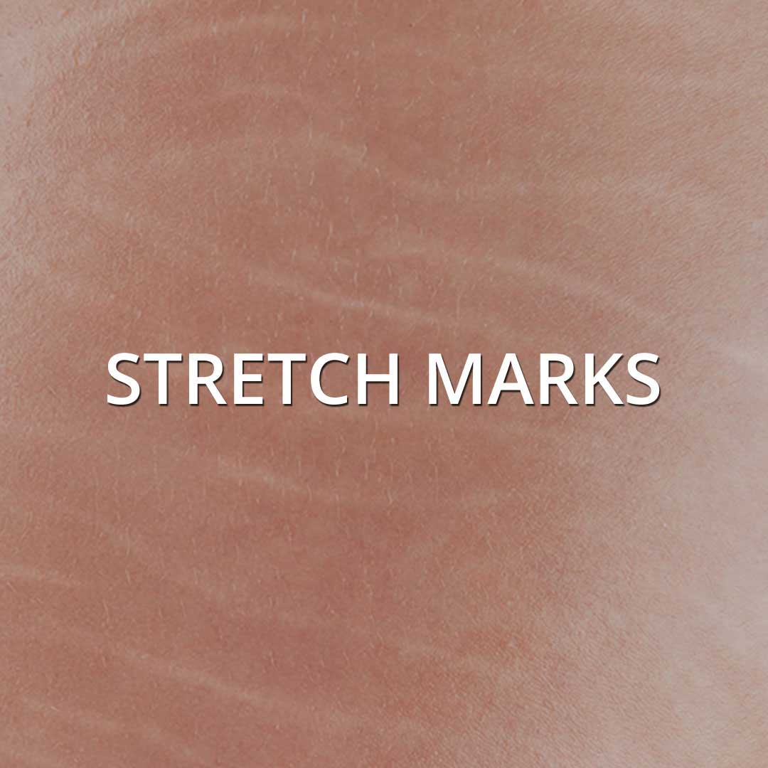 Stretch Marks