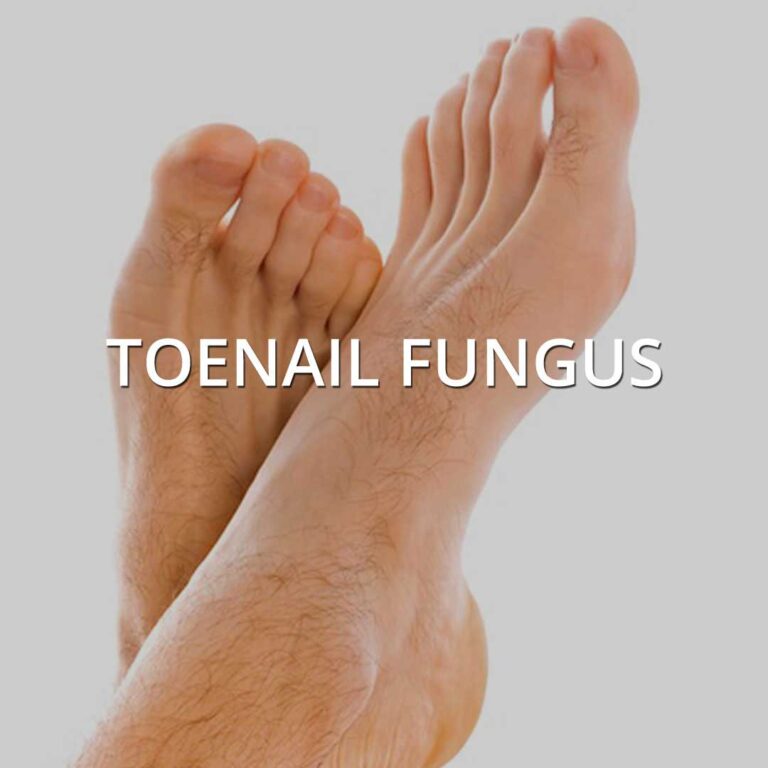 Toenail Fungus