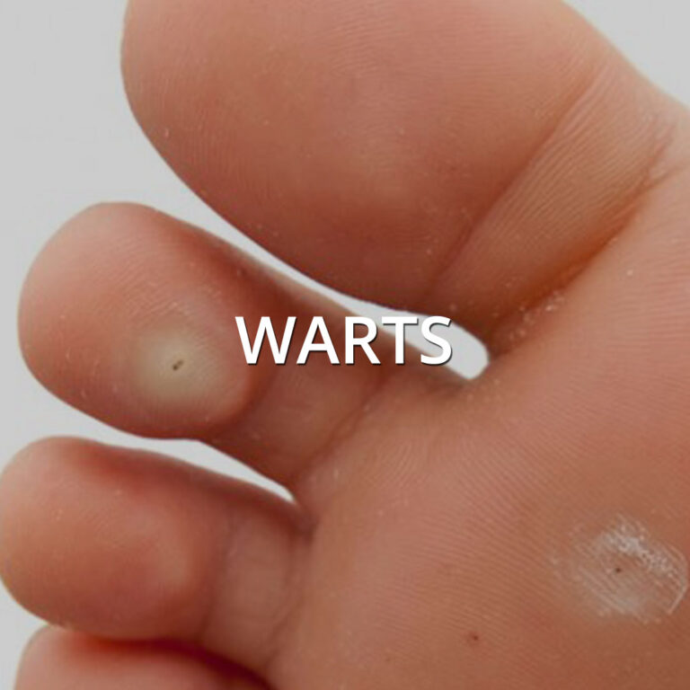 Warts