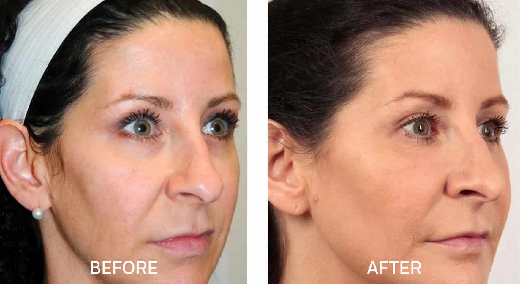 Fotona clinical before and after result 11