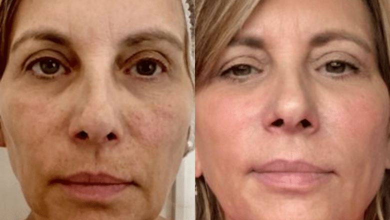 Fotona clinical before and after result 13