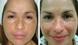 Fotona clinical before and after result 12