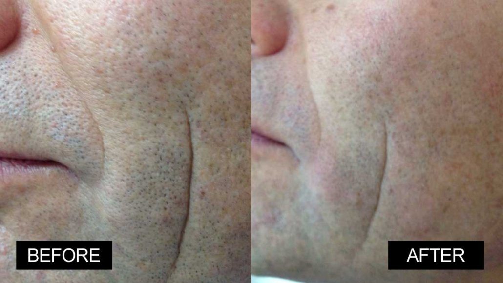 Fotona clinical before and after result 4