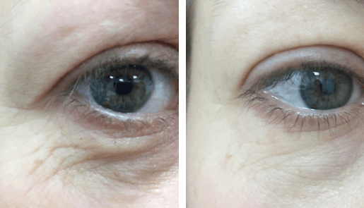 Fotona clinical before and after result 2