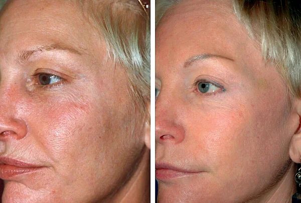 Fotona clinical before and after result 14