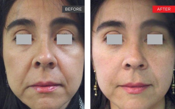 Fotona clinical before and after result 3