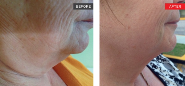 Fotona clinical before and after result 6