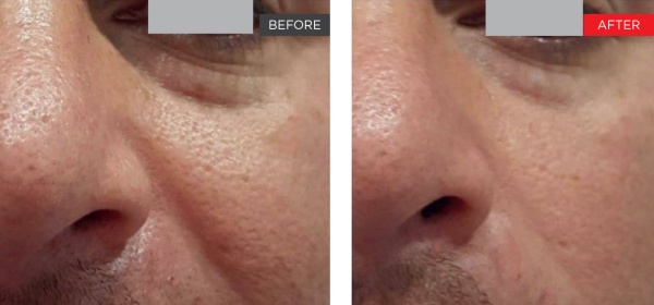 Fotona clinical before and after result 10