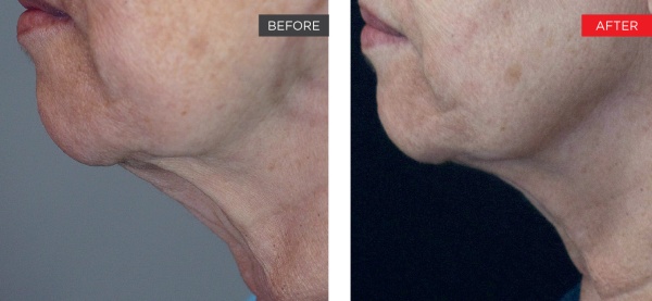 Fotona clinical before and after result 8