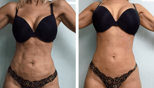 Fotona clinical before and after result 5
