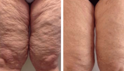 Fotona clinical before and after result 9