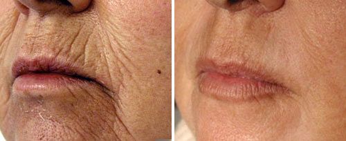 Fotona clinical before and after result 7
